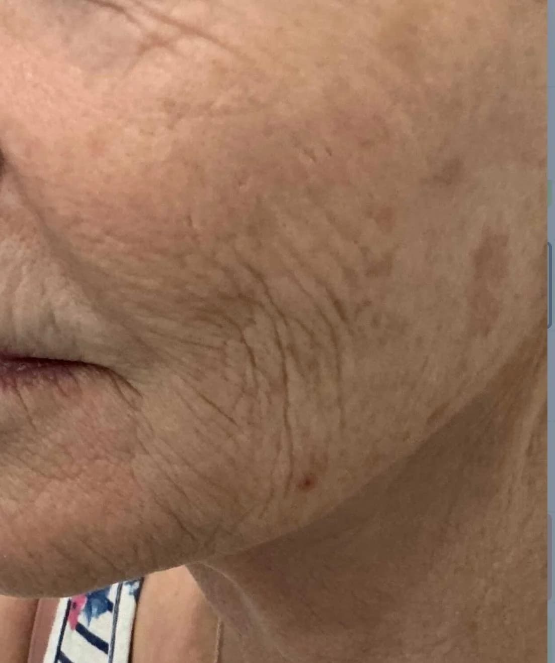 Cosmetische behandeling bij EmpowerBeauty Clinic – after treatment