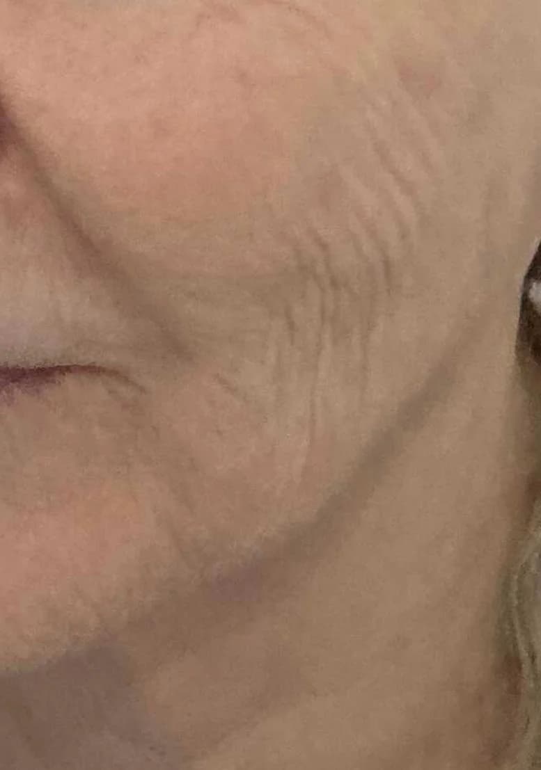 Cosmetische behandeling bij EmpowerBeauty Clinic – before treatment
