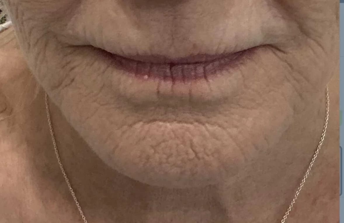 Cosmetische behandeling bij EmpowerBeauty Clinic – after treatment