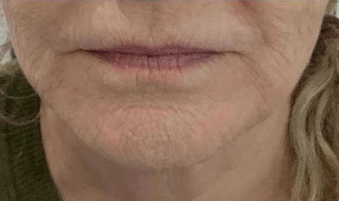 Cosmetische behandeling bij EmpowerBeauty Clinic – before treatment