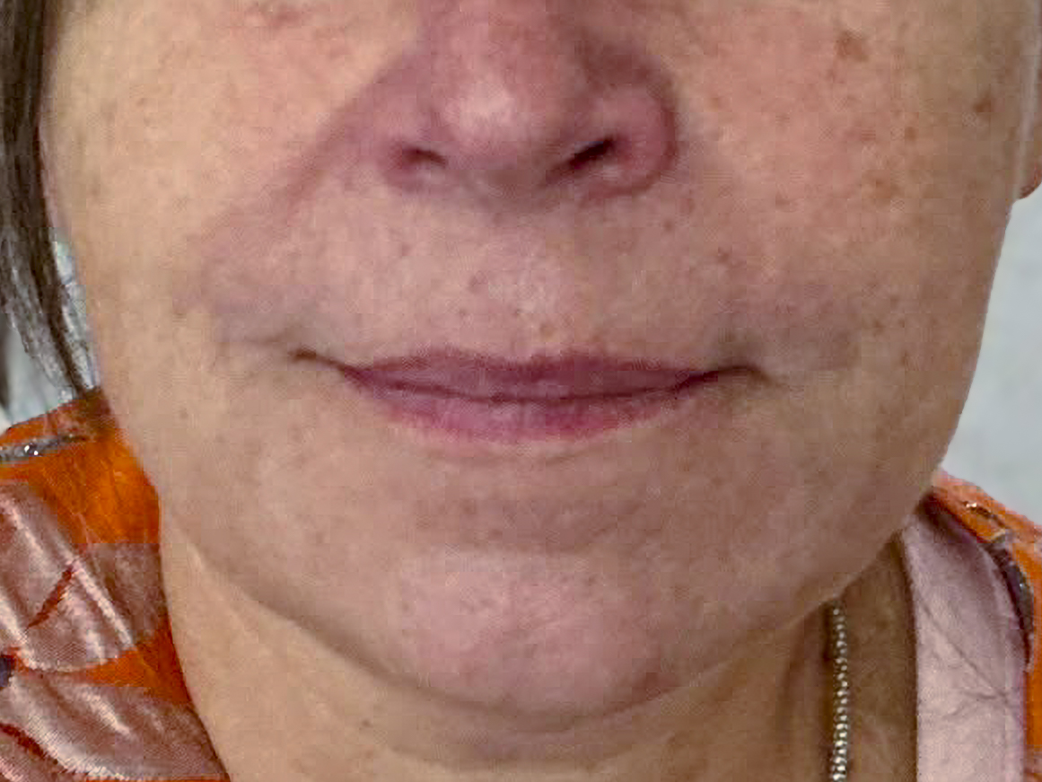 After marionette lines and nasolabial fold filler