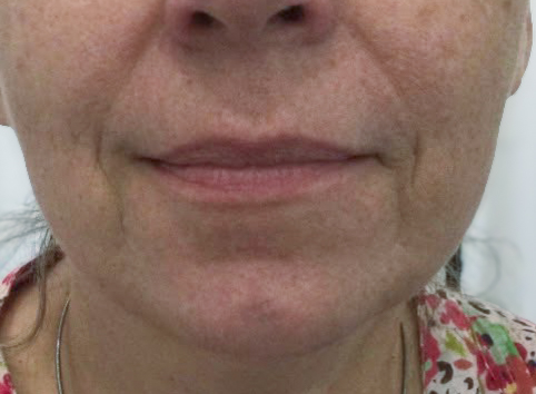Before marionette lines and nasolabial fold filler