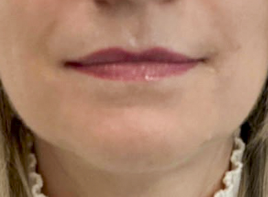 Before lip filler