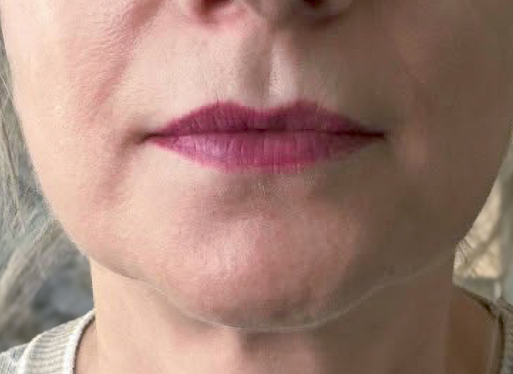 After lip filler